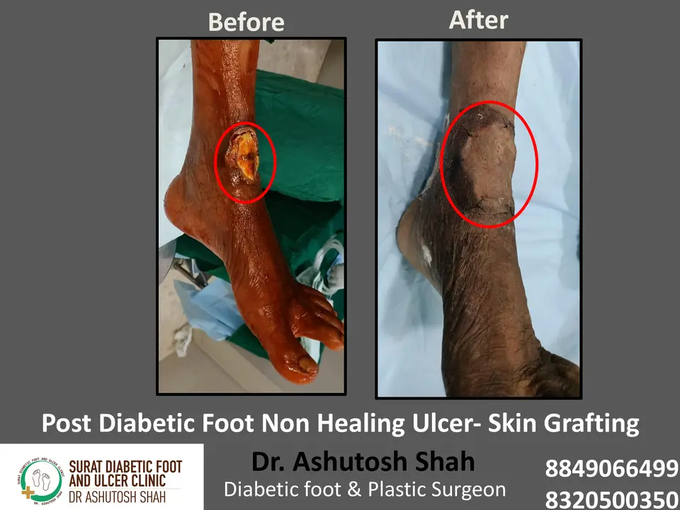 Diabetic Foot  PPT 3 checked by sir.pptx-15.webp